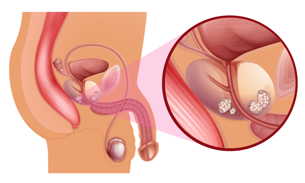 La prostata: cos'è e chi la cura