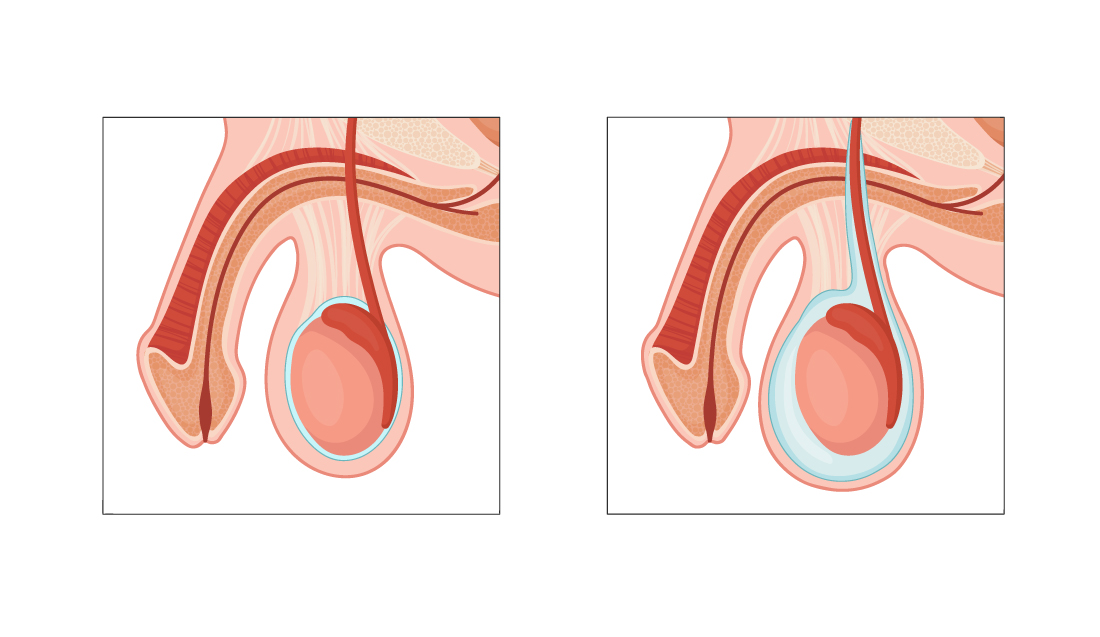 Idrocele: cause e cure